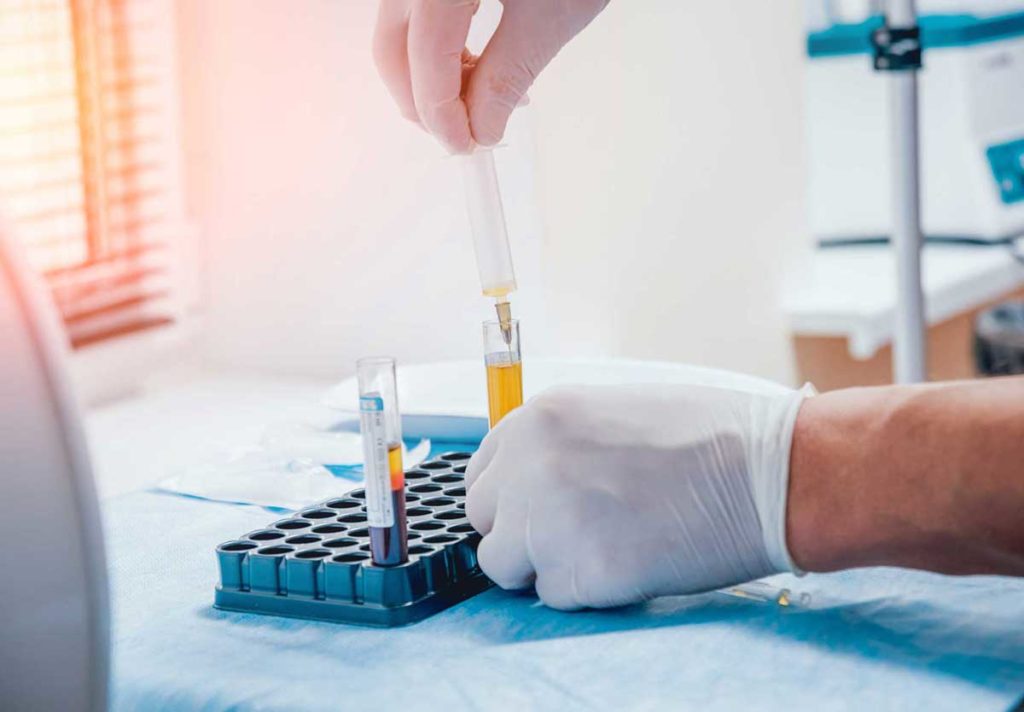 Platelet-Rich plasma preparation. Plasma in syringe. Centrifuge